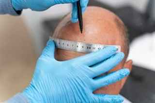 Personalized Care for FUE Hair Transplant