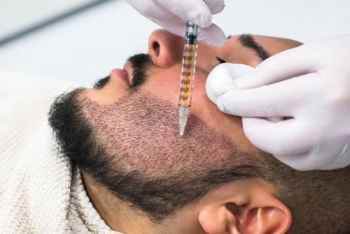 زراعة شعر اللحية