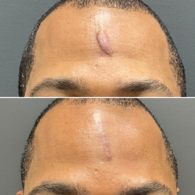 Surgical Scar Revision