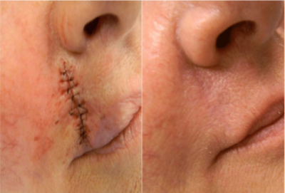 Surgical Scar Revision