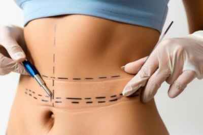 Liposuction Surgery in Dubai